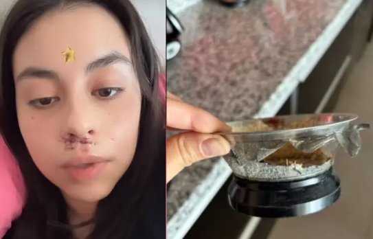 VIDEO: Mujer termina con puntadas en el rostro tras usar extractor comprado en Amazon