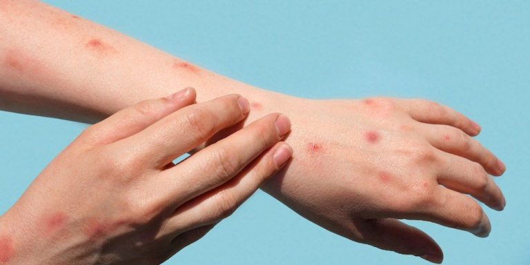 Identifican una nueva cepa de mpox, mejor conocida como ‘viruela del mono’